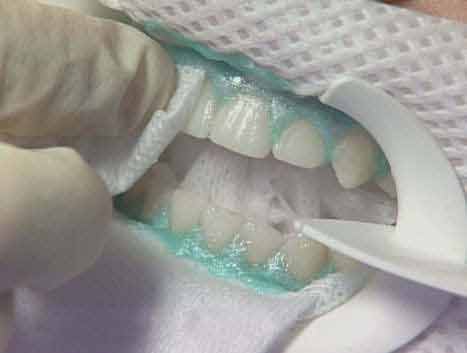 Отбеливание зубов стоматология Мытищи м. Медведково